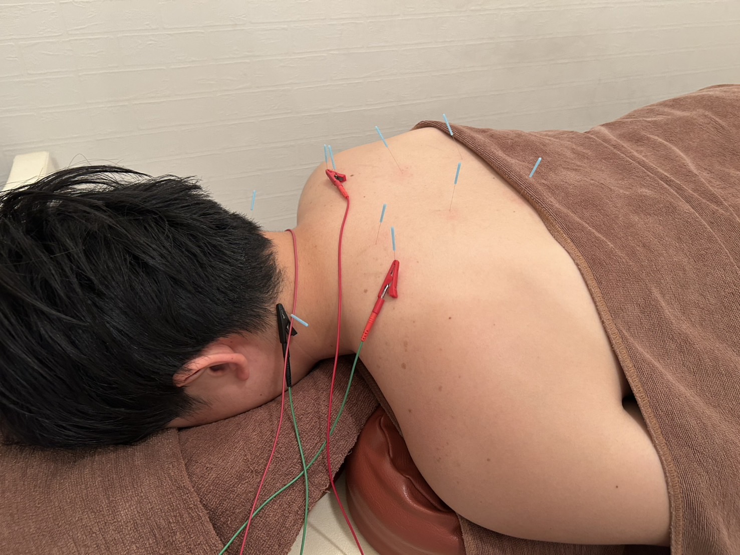 全身鍼灸